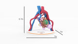 Lattice Pelvic Kidney With Neoplasm and Cysts - Male, 78 Years