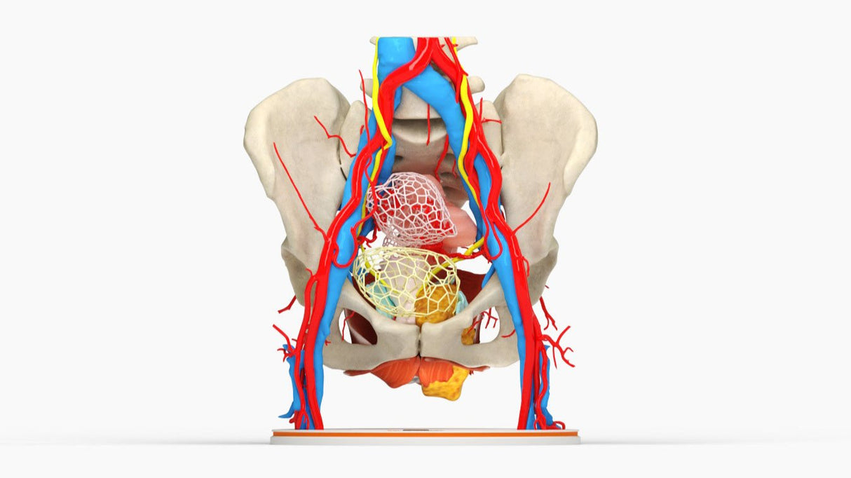 Pelvic Hernia – Female, 48 Years