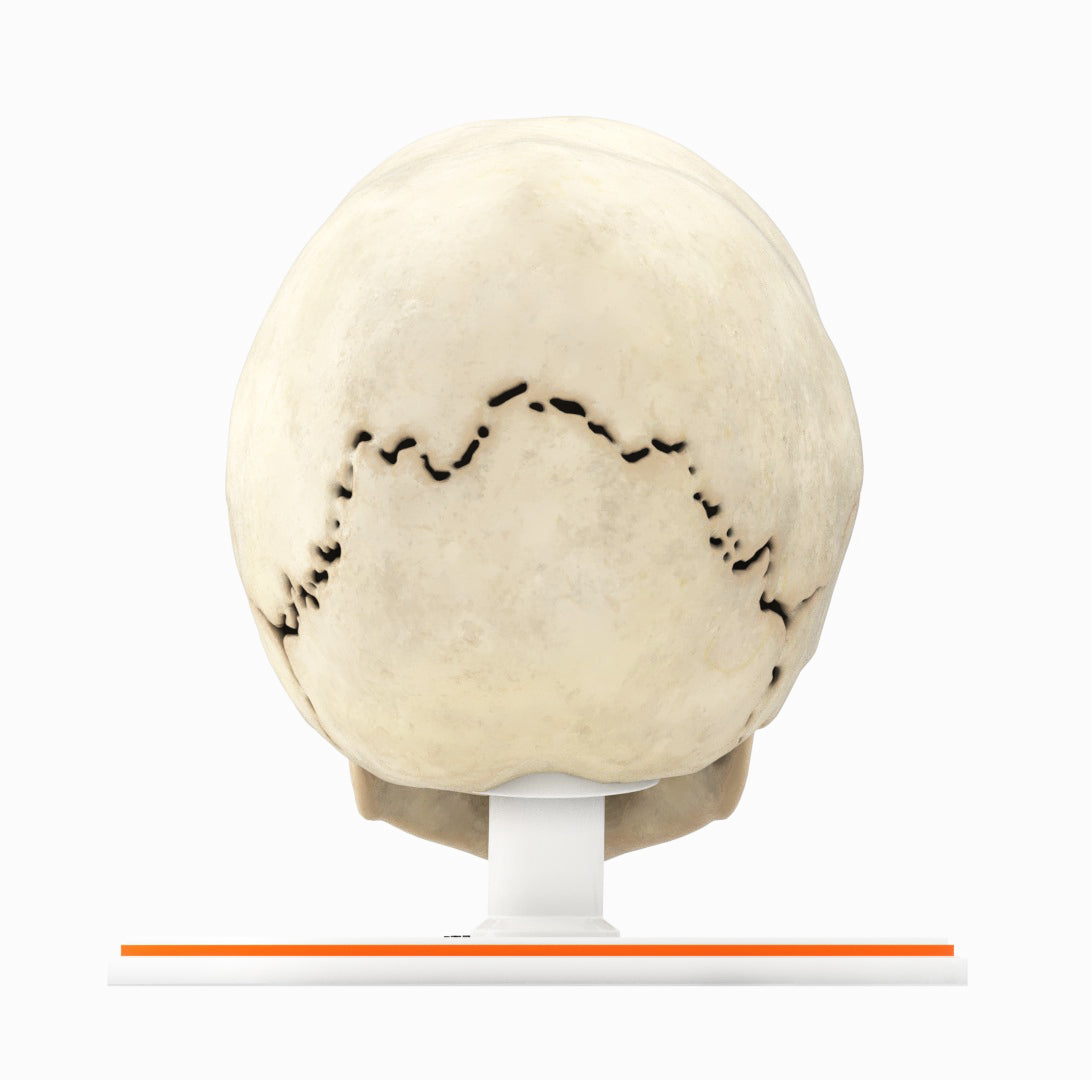 Infant Skull With Craniosynostosis of the Sagittal Suture - Male, 8 Months