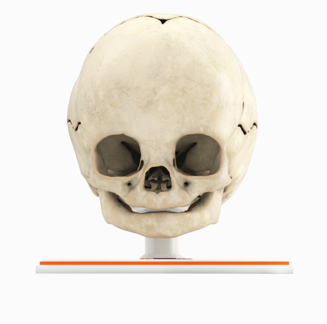 Infant Skull With Craniosynostosis of the Sagittal Suture - Male, 8 Months