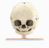 Infant Skull With Craniosynostosis of the Sagittal Suture - Male, 8 Months