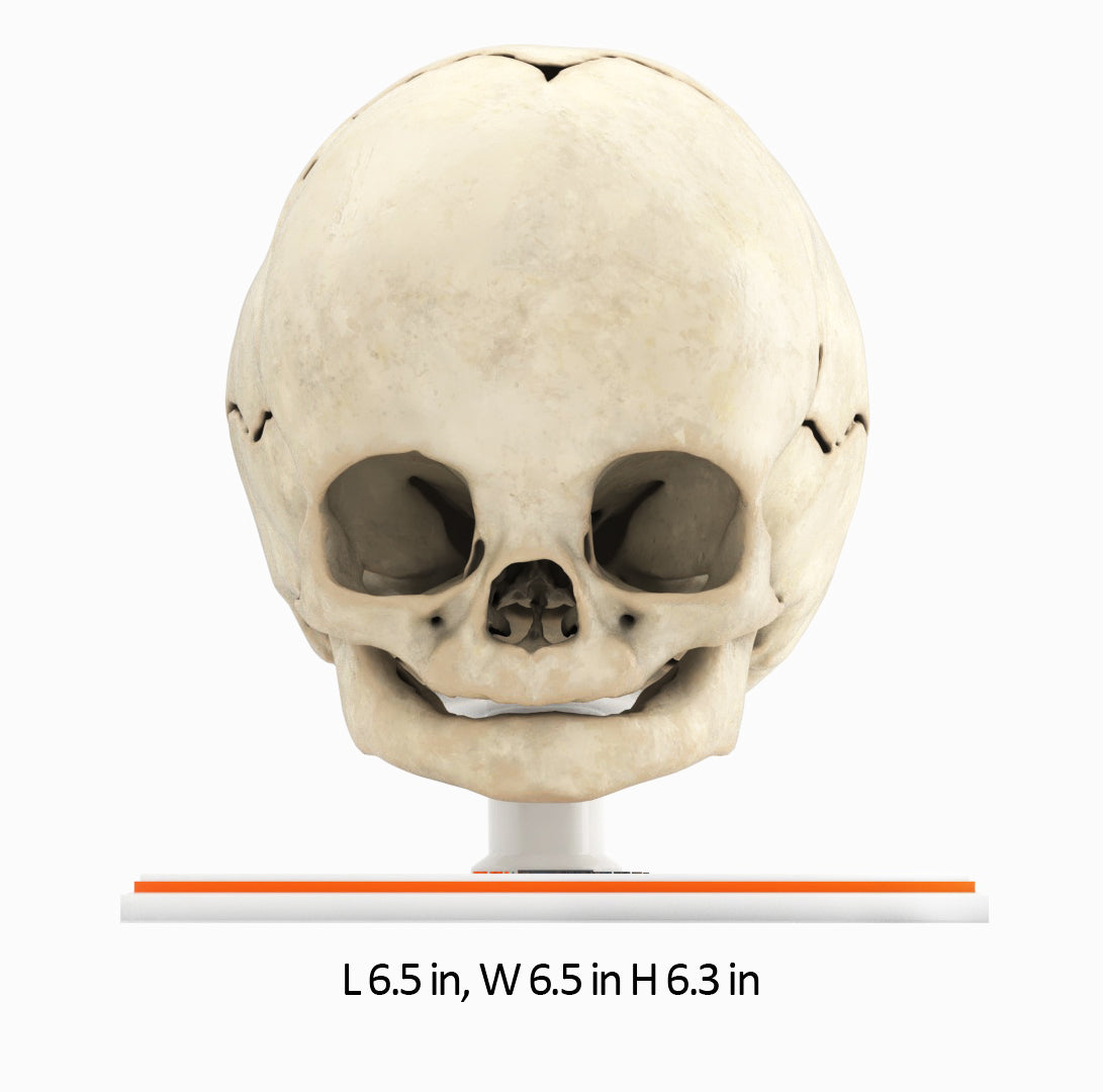 Infant Skull With Craniosynostosis of the Sagittal Suture - Male, 8 Months