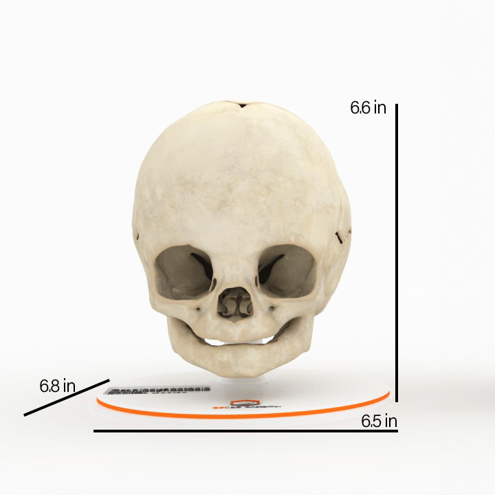 Infant Skull With Craniosynostosis of the Sagittal Suture - Male, 8 Months