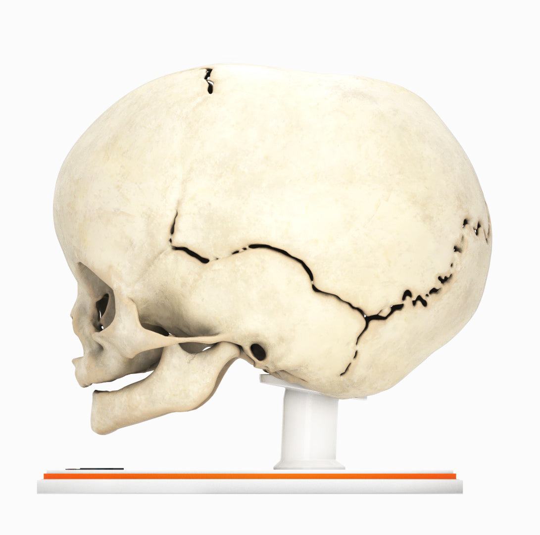 Infant Skull With Craniosynostosis of the Sagittal Suture - Male, 8 Months