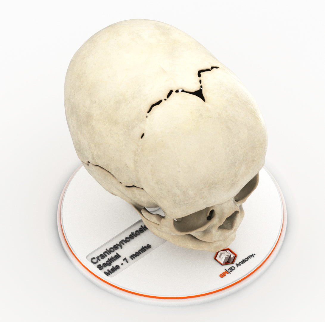 Infant Skull With Craniosynostosis of the Sagittal Suture - Male, 8 Months