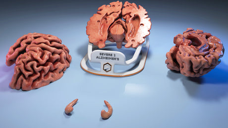 Adult Brain With Alzheimer’s Disease, Severe 2