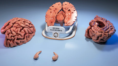 Adult Brain With Alzheimer’s Disease, Severe