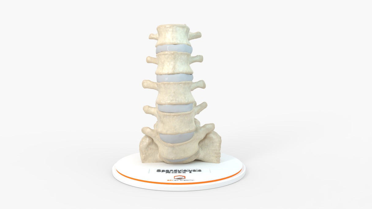 Spine With Bilateral Spondylolysis (Pars Defect), Grade 1 – Male, 27 years