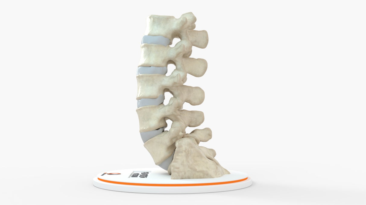 Spine With Bilateral Spondylolysis (Pars Defect), Grade 1 – Male, 27 years