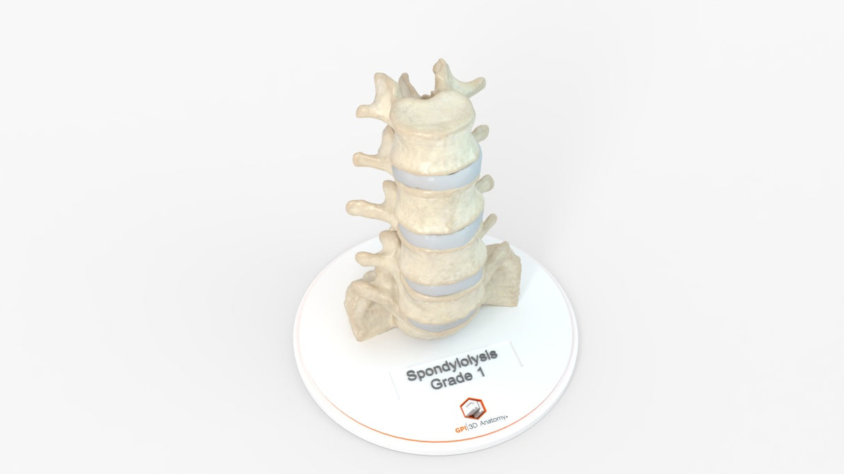 Spine With Bilateral Spondylolysis (Pars Defect), Grade 1 – Male, 27 years