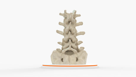 Spine With Bilateral Spondylolysis (Pars Defect), Grade 2 – Male, 27 years