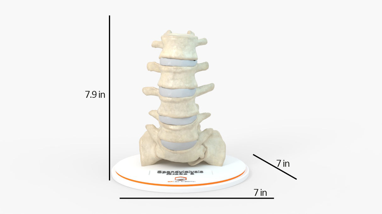 Spine With Bilateral Spondylolysis (Pars Defect), Grade 2 – Male, 27 years