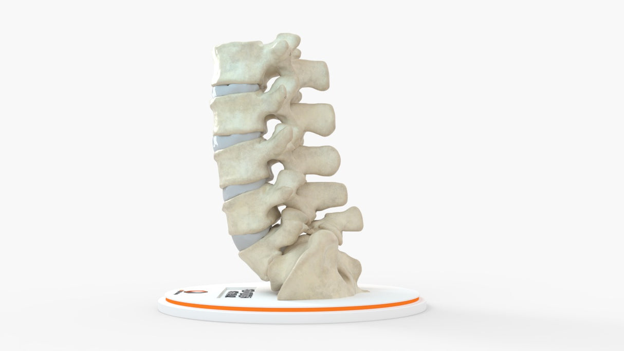 Spine With Bilateral Spondylolysis (Pars Defect), Grade 2 – Male, 27 years