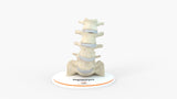 Spine With Spondylolisthesis (Anterolisthesis), Grade 3 – Female, 17 Years