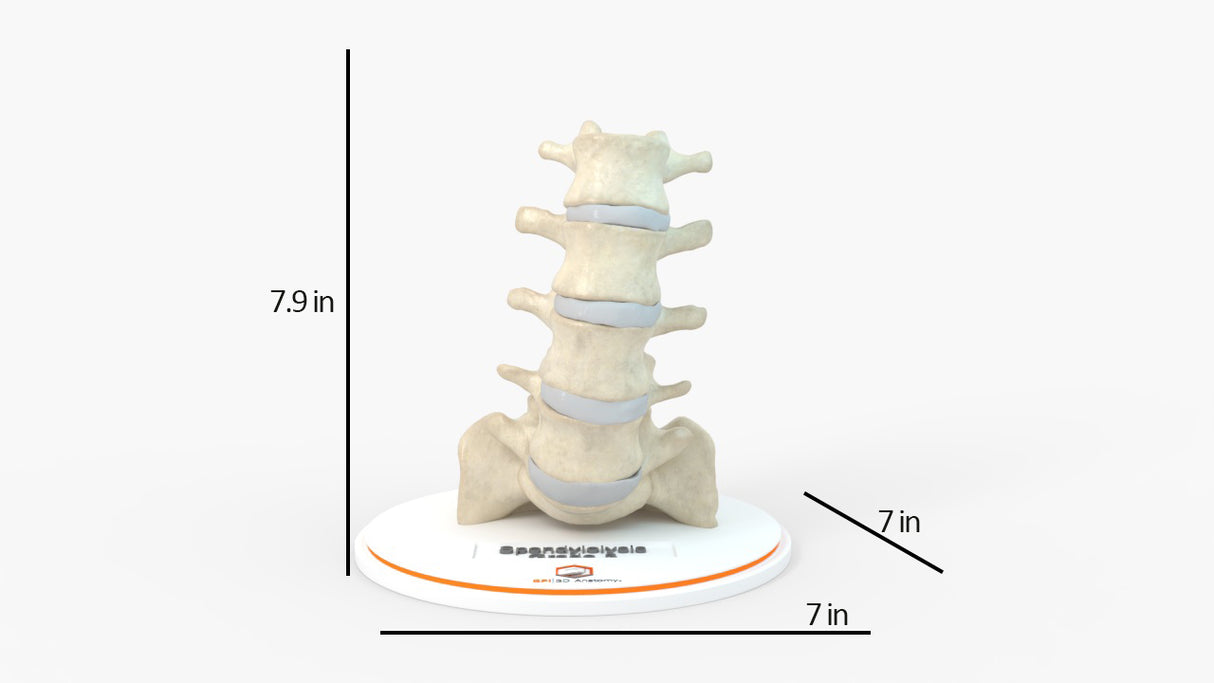 Spine With Spondylolisthesis (Anterolisthesis), Grade 3 – Female, 17 Years