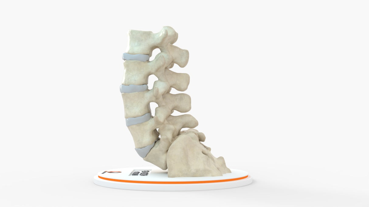 Spine With Spondylolisthesis (Anterolisthesis), Grade 3 – Female, 17 Years