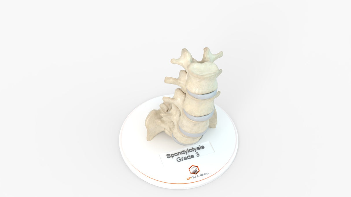 Spine With Spondylolisthesis (Anterolisthesis), Grade 3 – Female, 17 Years