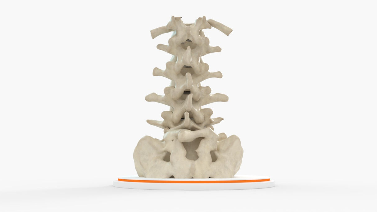 Spine With Spondylolysis (Pars Defect), Grade 4 – Female, 16 Years