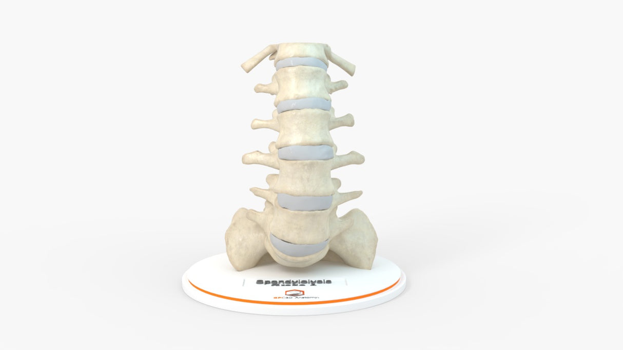 Spine With Spondylolysis (Pars Defect), Grade 4 – Female, 16 Years