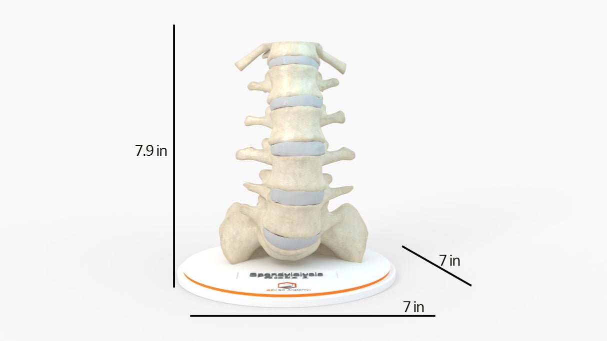 Spine With Spondylolysis (Pars Defect), Grade 4 – Female, 16 Years