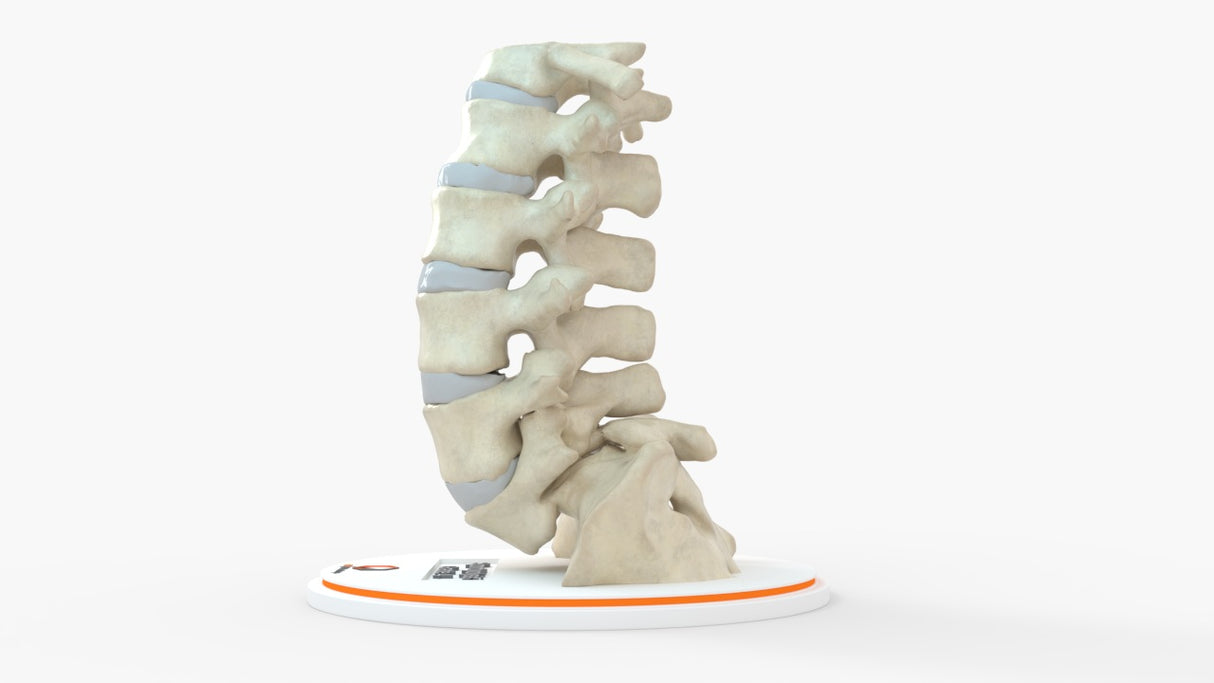 Spine With Spondylolysis (Pars Defect), Grade 4 – Female, 16 Years