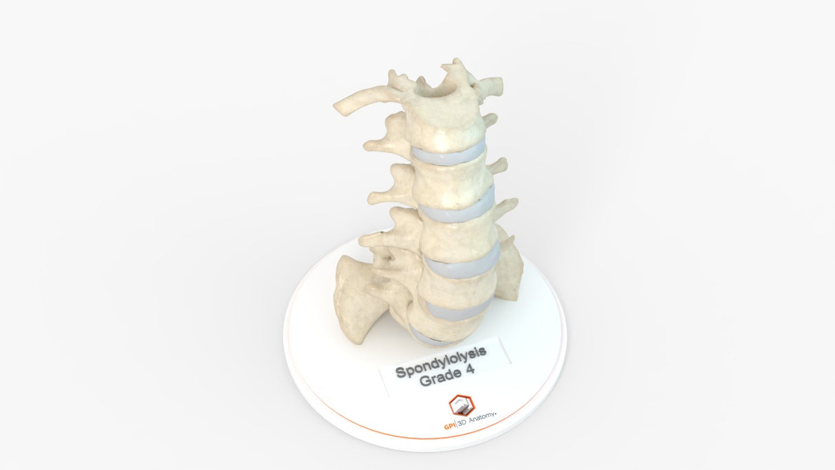 Spine With Spondylolysis (Pars Defect), Grade 4 – Female, 16 Years