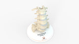 Spine With Spondylolysis (Pars Defect), Grade 4 – Female, 16 Years