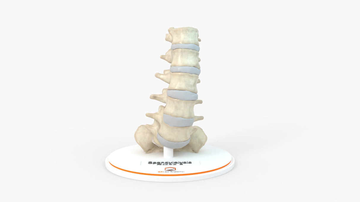 Spine With Spondylolisthesis (Anterolisthesis), Grade 5 - Multiple Patients, 12-27 Years