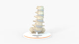 Spine With Spondylolisthesis (Anterolisthesis), Grade 5 - Multiple Patients, 12-27 Years