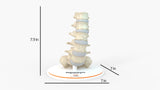 Spine With Spondylolisthesis (Anterolisthesis), Grade 5 - Multiple Patients, 12-27 Years