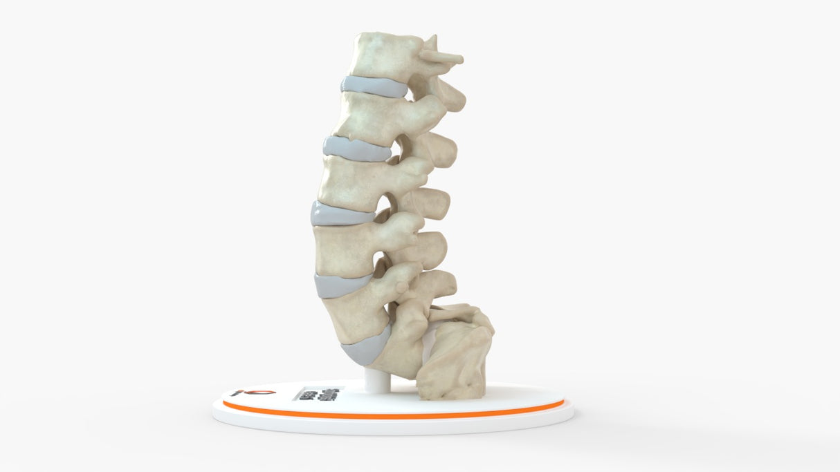 Spine With Spondylolisthesis (Anterolisthesis), Grade 5 - Multiple Patients, 12-27 Years