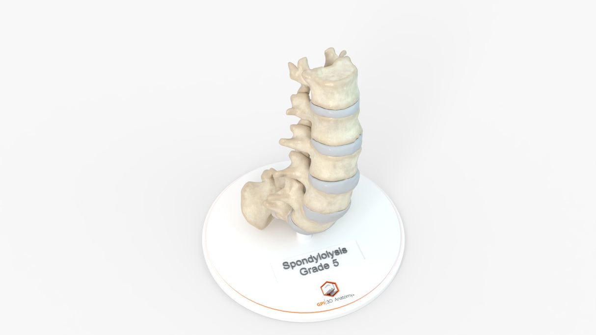 Spine With Spondylolisthesis (Anterolisthesis), Grade 5 - Multiple Patients, 12-27 Years