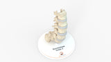 Spine With Spondylolisthesis (Anterolisthesis), Grade 5 - Multiple Patients, 12-27 Years