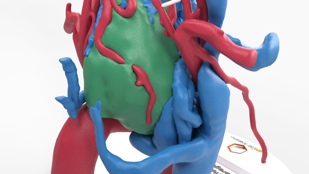 Chest With Mediastinal Paraganglioma – Male, 50 Years