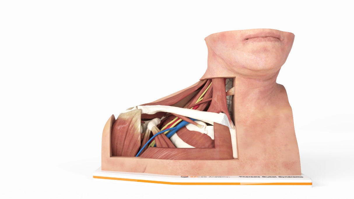 Thoracic Outlet Syndrome (TOS), Arm Down