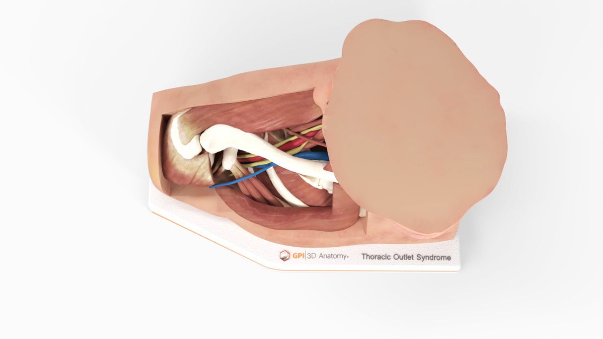 Thoracic Outlet Syndrome (TOS), Arm Down