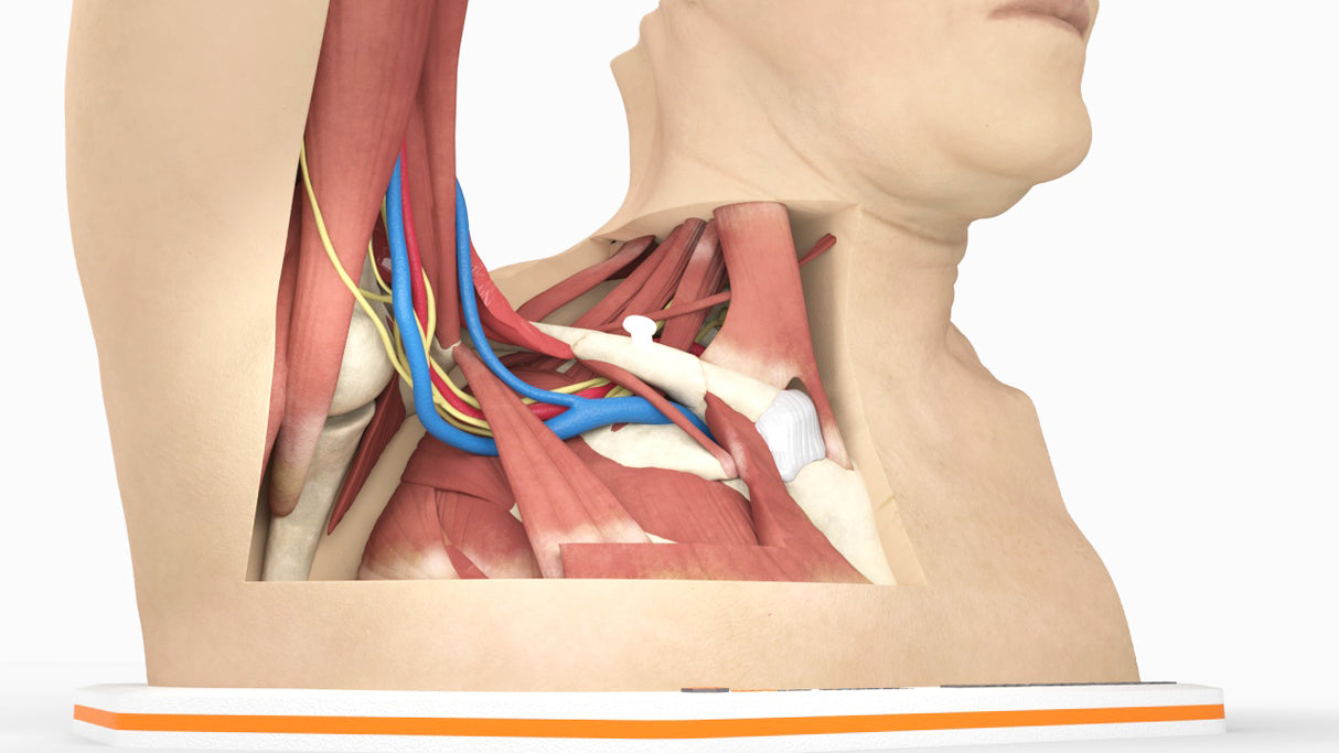 Thoracic Outlet Syndrome (TOS), Arm Up