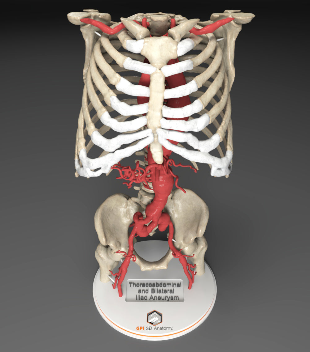 Custom 3D Anatomy Models | Aortic Aneurysm | Thoracoabdominal Bilateral ...