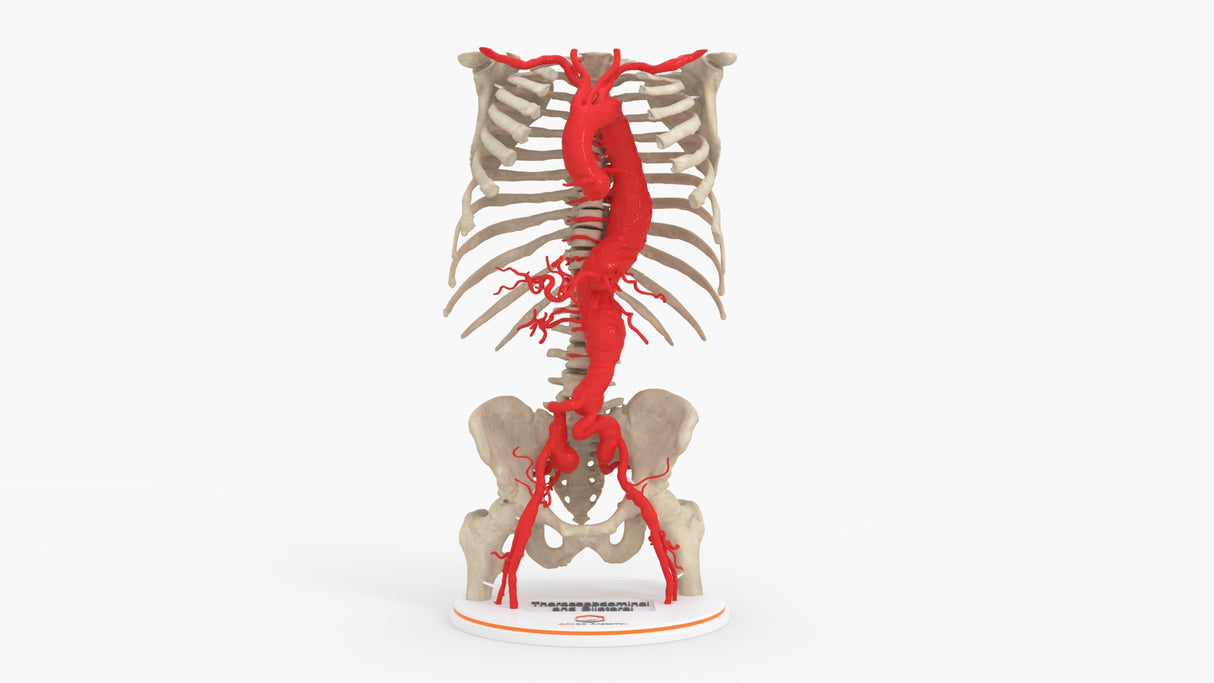 Thoracoabdominal and Bilateral Iliac Artery Aneurysm (IAA)