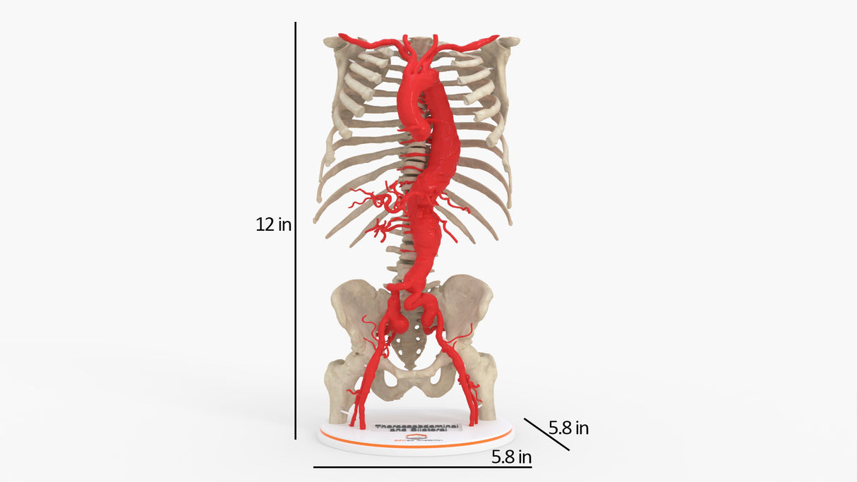 Thoracoabdominal and Bilateral Iliac Artery Aneurysm (IAA)