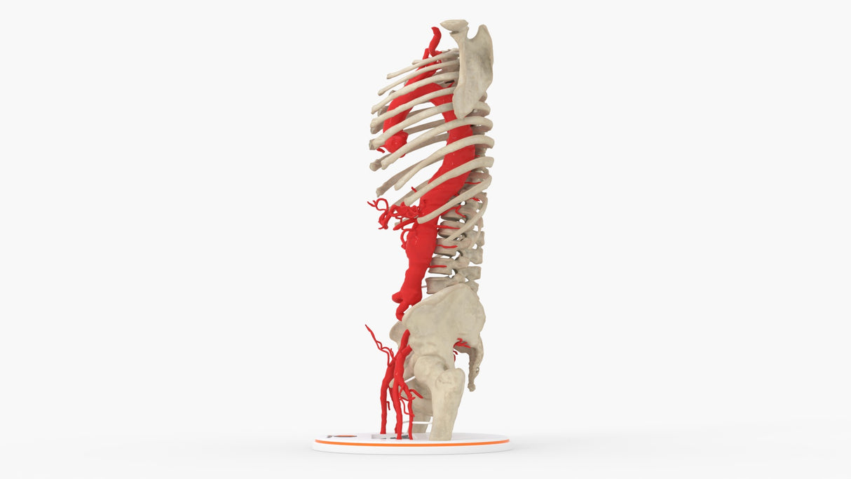 Thoracoabdominal and Bilateral Iliac Artery Aneurysm (IAA)