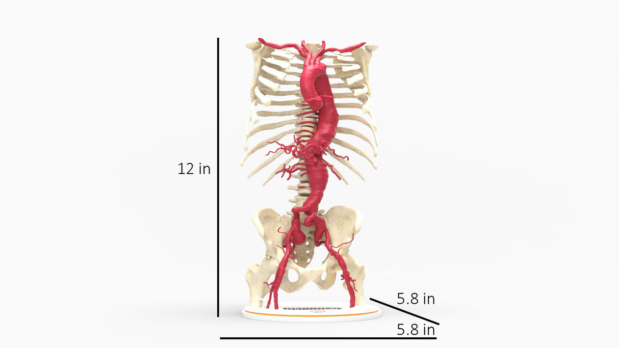 Thoracoabdominal and Bilateral Iliac Artery Aneurysm (IAA)