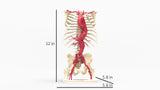 Thoracoabdominal and Bilateral Iliac Artery Aneurysm (IAA)