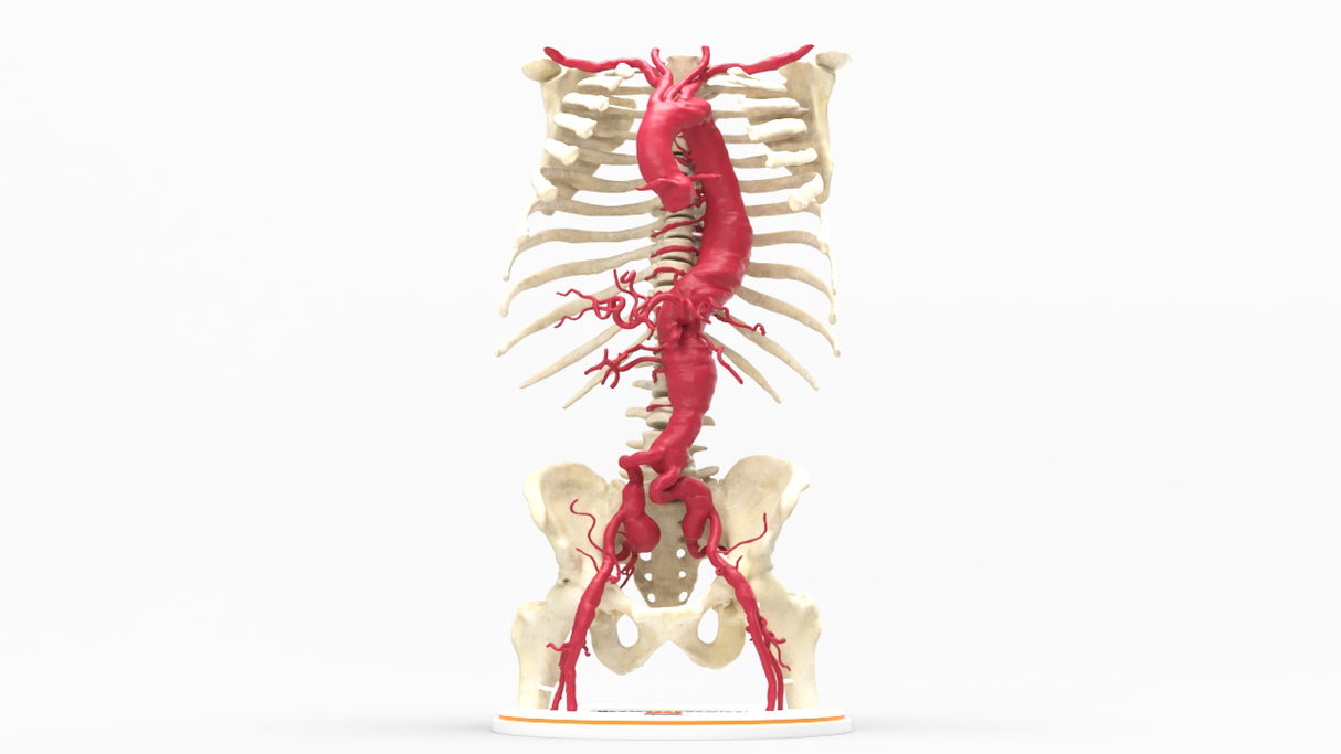 Thoracoabdominal and Bilateral Iliac Artery Aneurysm (IAA)