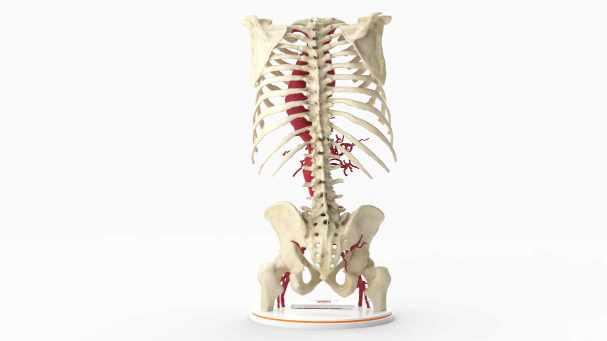 Thoracoabdominal and Bilateral Iliac Artery Aneurysm (IAA)