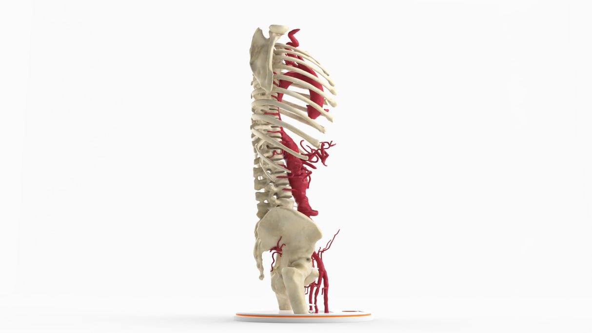 Thoracoabdominal and Bilateral Iliac Artery Aneurysm (IAA)