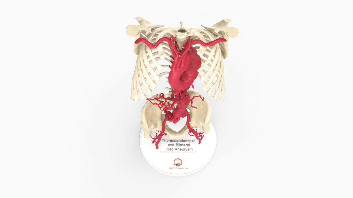 Thoracoabdominal and Bilateral Iliac Artery Aneurysm (IAA)