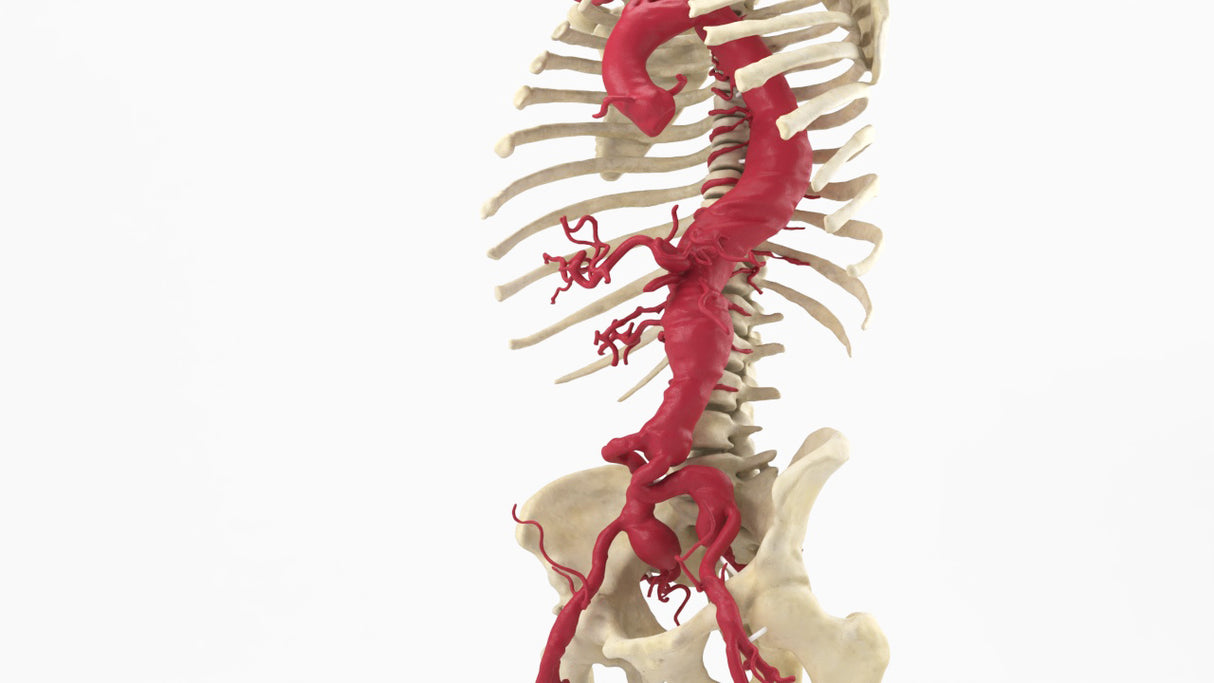 Thoracoabdominal and Bilateral Iliac Artery Aneurysm (IAA)