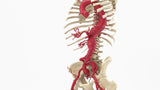 Thoracoabdominal and Bilateral Iliac Artery Aneurysm (IAA)