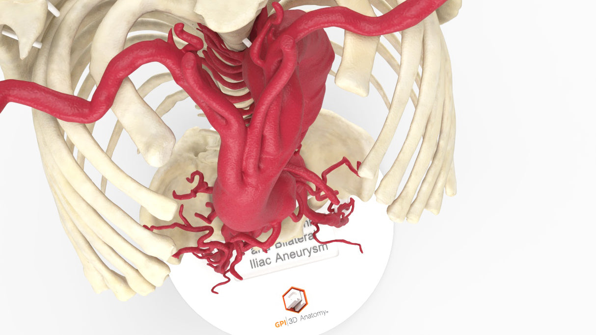 Thoracoabdominal and Bilateral Iliac Artery Aneurysm (IAA)